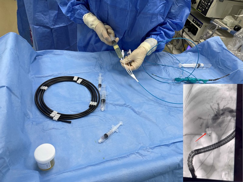 Hangzhou Místní top tři nemocnice pomocí našeho jednorázového kamenného balón...